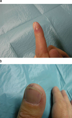 a) Pústula de base purpúrica con localización acral en paroniquio de dedo de mano. b) Hemorragia en astilla en pulpejo de primer dedo de mano.