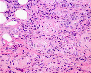 Fibrosis laminar concéntrica perivascular en la dermis (hematoxilina-eosina, 400×).