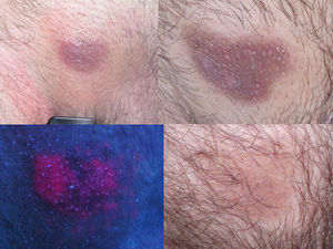 Imagen de un paciente tratado con TFD. A la izquierda arriba se aprecia la lesión y abajo la fluorescencia. A la derecha la imagen tras tres sesiones de TFD, y abajo pasados 3 meses de la quinta sesión, la infiltración de la lesión ha desaparecido.