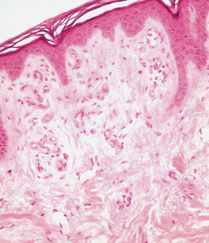 Hematoxilina-eosina, ×200: correspondiente a mácula hipopigmentada: ectasia vascular en dermis superficial con ausencia de infiltrado inflamatorio ni melanófagos.
