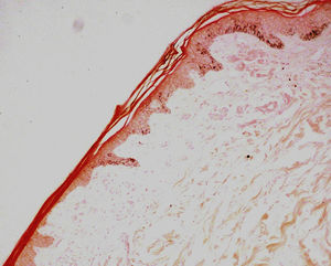 Masson-Fontana, ×40: corte histológico de la zona de transición entre la piel pigmentada normalmente y la mácula acrómica, con ausencia total de melanocitos en esta última.
