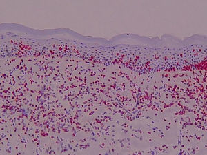 Intensa expresión del antígeno ICAM-3 en el infiltrado tumoral. Biopsia cutánea, material congelado (×40).