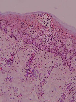 Marcaje de células del infiltrado dérmico y epidérmico, queratinocitos y endotelios vasculares con anti-ICAM-1. Biopsia cutánea, material congelado (×100).