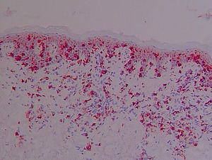 El infiltrado linfoide dérmico y epidérmico y las células de Lagerhans presentan una intensa inmunotinción con anti-CLA. Biopsia cutánea, material congelado (×40).