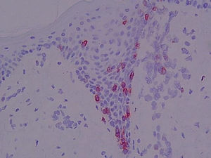 Expresión del antígeno CD103 por linfocitos localizados en epidermis. Biopsia cutánea, material congelado (×400).