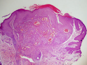 Proliferación celular epitelioide bien delimitada, unilobular, localizada en dermis superficial. Obsérvese la hiperplasia epidérmica acompañante.