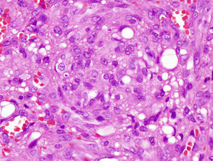 Detalle de las células epitelioides, dispuestas en patrón sólido. Pequeñas luces vasculares.