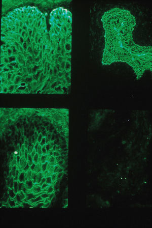 Caso 1: inmunofluorescencia indirecta. IgG circulante que marca sustancia intercelular y membrana basal del epitelio de esófago de mono y vejiga de rata (izquierda) en comparación con el testigo, pénfigo vulgar, donde la IgG circulante solamente marca en epitelio de esófago de mono (derecha).