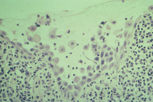 Caso 1: biopsia de esófago. H-E 20×. Acantólisis a nivel de las células basales con signos de necrosis y espongiosis.