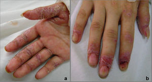 Caso 2: a) Lesiones erosivas y fisuras en palmas de manos. b) Inflamación periungueal con onicodistrofia.