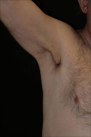 Imagen clínica, que muestra una placa marronácea indurada no bien definida con un borde perlino periférico.