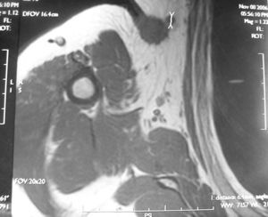 La imagen obtenida mediante RMN mostró un nódulo de 0,4cm proximal a la tumoración primaria.