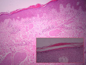 Infiltrado perivascular superficial con foco de espongiosis epidérmica y paraqueratosis (hematoxilina-eosina, x 40).