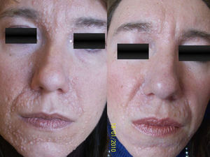 Mujer de 43 años con síndrome de Brooke-Spiegler. Tratamiento mediante vaporización con láser CO2 de onda continua, antes y 5 meses después del tratamiento.