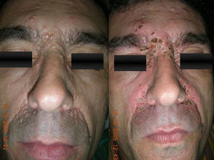 Varón de 43 años con síndrome de Brooke-Spiegler. Formación de costras inmediatamente tras la vaporización con láser CO2 de onda continua a 5W de potencia.