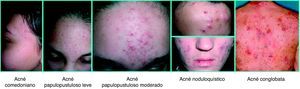 Imágenes clínicas representativas de las diferentes formas de acné, ordenadas según su gravedad, que se utilizaron en la encuesta para consensuar el algoritmo español del tratamiento del acné.