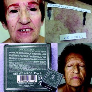 Eczema de contacto facial por imidazolidinil urea presente en polvos de maquillaje que se resolvió al evitar formaldehído y liberadores de formaldehído.