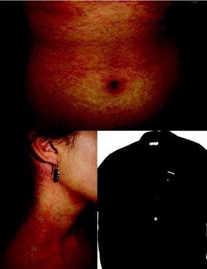 Dermatitis de contacto de distribución generalizada desencadenada por un uniforme nuevo de trabajo en una paciente alérgica a formaldehído.