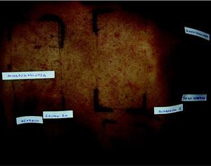 Pruebas epicutáneas positivas para múltiples liberadores de formaldehído de distinto grupo químico. Esto debe ser interpretado como alergia a formaldehído y, por tanto, el paciente debería evitar todas las fuentes liberadoras del mismo.