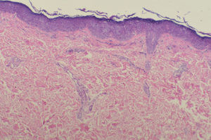 Biopsia de una lesión del tronco donde se observa hiperqueratosis con ligera paraqueratosis y leve acantosis con desorganización de la capa espinosa de tipo bowenoide. (hematoxilina-eosina, x100).