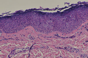 En la capa granulosa y parte alta de la espinosa células de citoplasma pálido y halo claro perinuclear característico de las verrugas planas (hematoxilina-eosina, x250).
