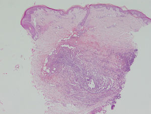 Microabscesos multifocales y hematíes extravasados en la dermis media y profunda (hematoxilina-eosina x2).