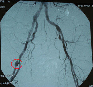 En la arteriografía se observa un pseudoaneurisma en la arteria femoral profunda derecha (área bajo el círculo).