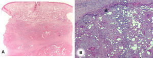 A. Reacción granulomatosa en la dermis profunda y el tejido celular subcutáneo (HE x20). B. Detalle de los granulomas sarcoideos (PAS x100).