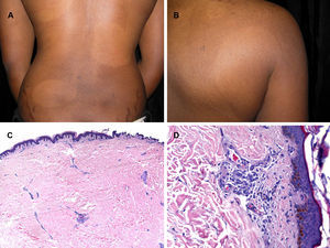 Caso 3. Diagnosticada de lepra indeterminada. Placas anulares hipopigmentadas, serpinginosas, de límites precisos y tamaño variable, algunas confluentes, distribuidas en la espalda y el abdomen. (A y B). En la biopsia cutánea se observó un leve infiltrado linfohistiocitario en la dermis superficial y profunda (hematoxilina-eosina, C x100, D x300) sin observarse bacilos con la técnica de Ziehl-Neelsen.