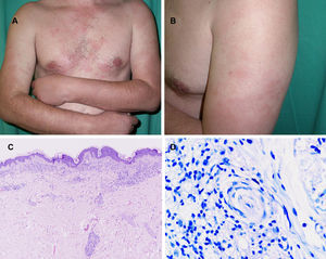 Caso 6. Diagnosticado de lepra borderline tuberculoide. Se aprecian máculas eritematosas distribuidas simétricamente en el tronco (A) y las extremidades (B). En la imagen histopatológica (hematoxilina-eosina, C x100, D x300) se observó un infiltrado difuso en la dermis papilar que se extiende a la dermis reticular y se dispone de forma perivascular, perianexial y perineural. Se observa una banda de dermis superficial respetada (zona Grenz). La tinción Ziehl-Neelsen fue negativa.