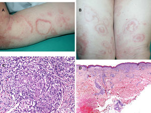 Caso 7. Diagnosticado de lepra borderline tuberculoide. Se observan placas anulares de borde eritematoso e infiltrado al tacto y con centro más claro distribuidas en extremidades superiores e inferiores (A y B). La histopatología de la lesión del brazo nos muestra una inflamación granulomatosa con formación de granulomas (C: hematoxilina-eosina, x300). La biopsia del muslo mostró en la dermis papilar un intenso y difuso infiltrado inflamatorio con afectación perivascular, perianexial y perineural (D: hematoxilina-eosina, x100).