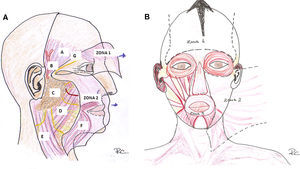 Zonas del sistema musculoaponeurótico superficial. A (visión lateral) y B (visión frontal). En la figura 2 A el SMAS se ha levantado mostrando el plano profundo. Se observa cómo es algo discontínuo a nivel del cigoma. En la Zona 1 el SMAS envuelve al músculo frontal (visto por transparencia). A nivel de la sien la rama temporal del nervio facial discurre en el SMAS, siendo especialmente vulnerable a nivel del cigoma donde se encuentra debajo de la grasa subcutánea. En la Zona 2 las ramas del nervio facial (en amarillo) y el conducto parotídeo (en rojo) discurren profundas al SMAS y superficiales al músculo masetero y al cuerpo adiposo del carrillo. A: Fascia temporal (fascia profunda). B: Arteria temporal superficial. C: Glándula parótida. D: Músculo masetero y cuerpo adiposo del carrillo. E: Músculo esternocleidomastoideo. F: Músculo platisma. G: Rama temporal del nervio facial.