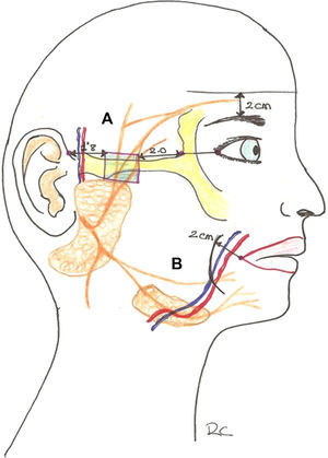 A. Punto crítico y localización de la rama temporal del facial. B: Punto crítico y localización de la rama marginal mandibular del facial.