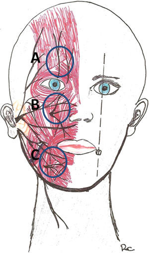 Puntos críticos de las ramas nerviosas sensoriales. A: Ramas supraorbitaria y supratroclear (ramas de la oftálmica V1). B: Rama infraorbitaria (V2). C: Nervio mentoniano (V3).