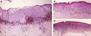 (A) La histopatología de la lesión de mayor tamaño mostró un melanoma de extensión superficial, Clark IV y Breslow de 2,5mm (hematoxilina-eosina x100). (B) A mayor aumento vemos un intenso componente pagetoide, hallazgo típico de los melanomas primarios (hematoxilina-eosina x200). (C) La histopatología de una de las lesiones de pequeño tamaño nos muestra una lesión de contornos bien definidos en la dermis superficial, sin presentar actividad en la unión dermo-epidérmica ni componente inflamatorio o pagetoide (hematoxilina-eosina x40).