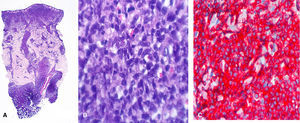 A y B. Infiltrado de células de aspecto mielodisplásico y nucléolo prominente (HE, x2). C. Positividad difusa para CD123 (x10).