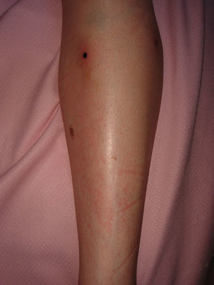 Aspecto clínico de 2 nódulos subcutáneos en la pierna izquierda, tras la realización de las biopsias cutáneas.