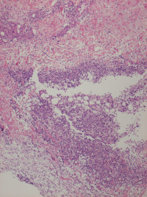 Aspecto anatomopatológico del denso infiltrado inflamatorio que ocupa la dermis reticular y la hipodermis, dentro del cual se aprecia la disposición de múltiples estructuras redondeadas pálidas con centro hipercromático (hematoxilina-eosina x100).