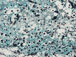 Aspecto anatomopatológico de las esporas de criptococo con tinción de plata (x400).