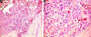 Imagen histológica de una de las biopsias del muslo: zonas hemorrágicas y múltiples trombos hialinos junto con recanalización capilar (A. Hematoxilina eosina x10) y detalle (B. Hematoxilina-eosina x40).