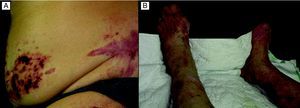 Lesiones residuales de episodios anteriores en la zona lumbar (A) y en las extremidades inferiores, con amputación de los dedos del pie derecho (B).