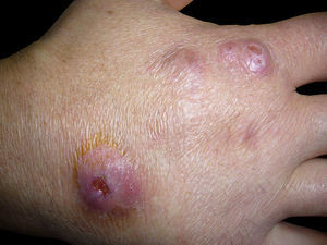 Abscesos purulentos en el dorso de la mano.