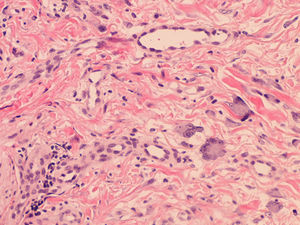 Hematoxilina-eosina x100. En la dermis se observa una proliferación vascular, infiltrado mixto y células gigantes multinucleadas de contornos angulados.