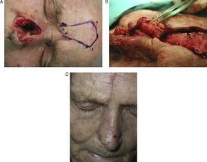 A. Defecto quirúrgico. Se dibuja el pedículo en la porción medial de la ceja y la plantilla del defecto en la región frontal (paciente 7). B. Por encima de la ceja (2cm) se despega en un plano profundo, intentando visualizar la arteria. C. Resultado final a los 6 meses tras realización de colgajo frontonasal paramedial (paciente 7).