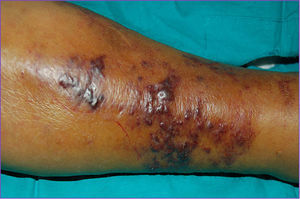 Placa indurada y eritematosa compuesta de numerosas lesiones purpúricas y vesículo-ampollosas de contenido necrótico y hemorrágico, localizada en el tercio inferior y medio de la región pretibial izquierda.