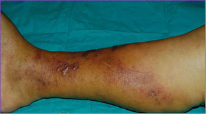Lesiones en la pierna derecha, vesículo-ampollosas con contenido hemorrágico, junto a empastamiento en el territorio venoso de la vena safena derecha.