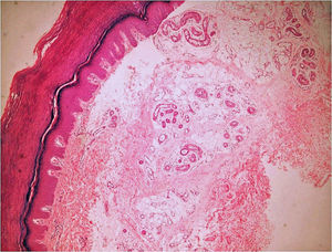 Imagen de la biopsia del caso 2. Proliferación hamartomatosa de glándulas ecrinas, capilares, tejido adiposo y colágeno desestructurado (H-E, x40).