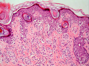 Crecimiento radial del melanoma. Se observan tecas en la dermis de menor tamaño que en la epidermis y ausencia de mitosis (H-E, x 200).