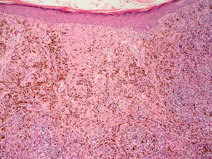Regresión del melanoma con sustitución del tumor por fibrosis, intensa melanofagia y vasos neoformados perpendiculares a la epidermis (H-E, x 100).