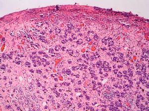 Melanoma de células pequeñas. Se observan nidos compactos con células de núcleo hipercromático y escaso citoplasma (H-E, x 100).